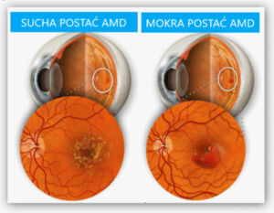 Infografika przedstawiająca wygląd zwyrodnienia plamki żółtej w oku (AMD) w postaci mokrej i suchej