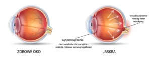 Infografika przedstawiająca wygląd i opis oka zdrowego i oka z jaskrą