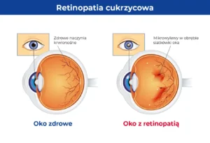 Infografika przedstawiająca wygląd i opis oka zdrowego i oka z retinopatią cukrzycową