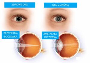 Infografika przedstawiająca oko zdrow i oko z zaćmą, wygląd soczewki oka